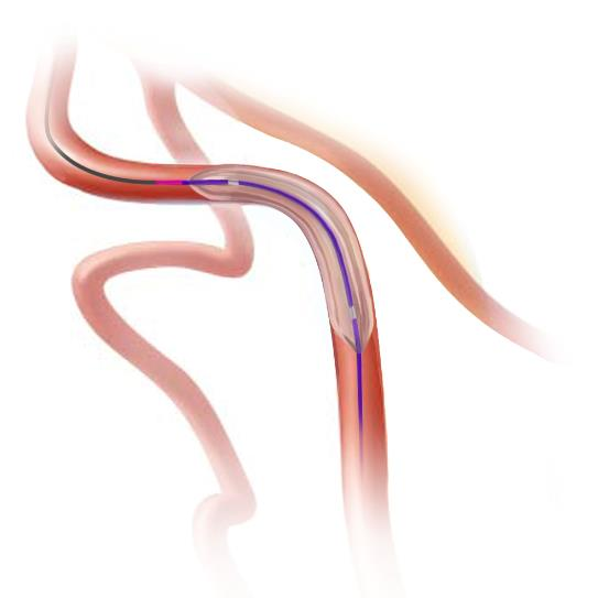 海绅?Vglad?颅内球囊扩张导管(图2)